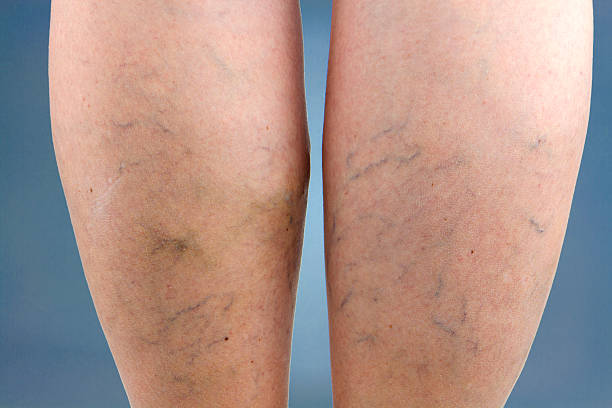 Love Your Legs: Tips for Varicose Vein Prevention