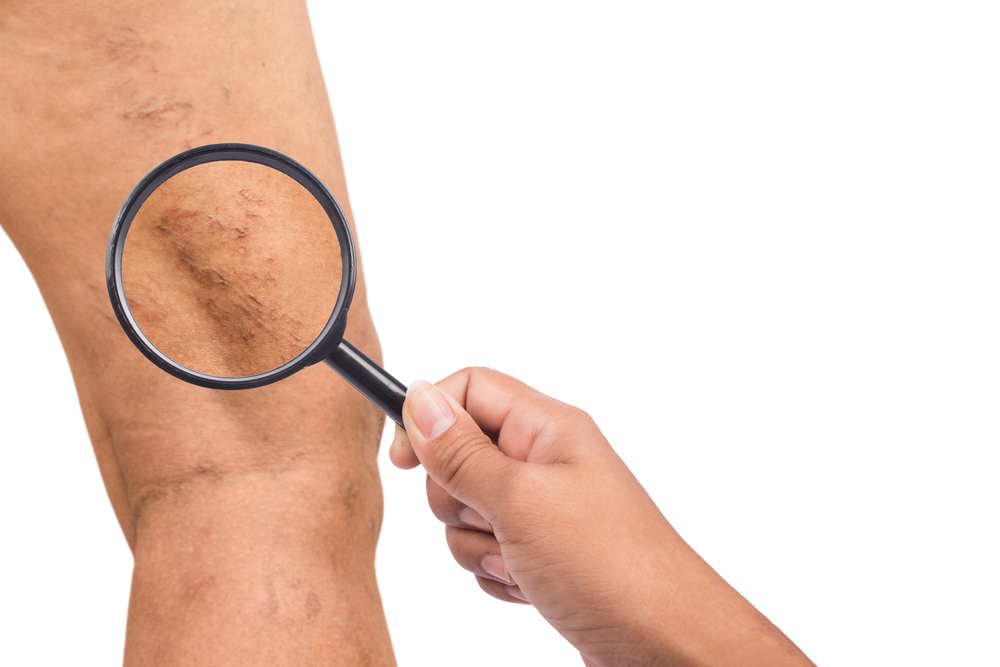 Untreated Varicose Veins