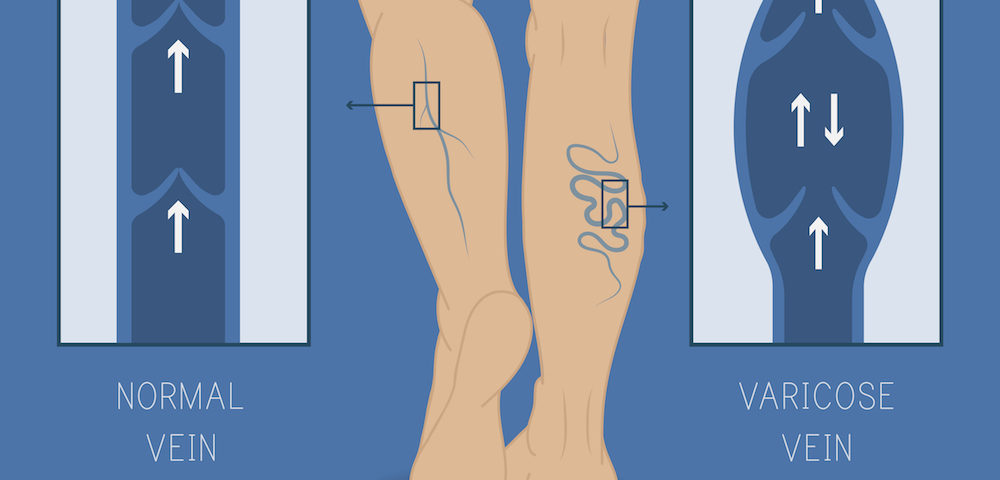 Types of Vein Conditions