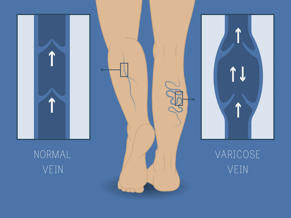 Spider Veins Along the Ankle Indicate Underlying Reflux Disease