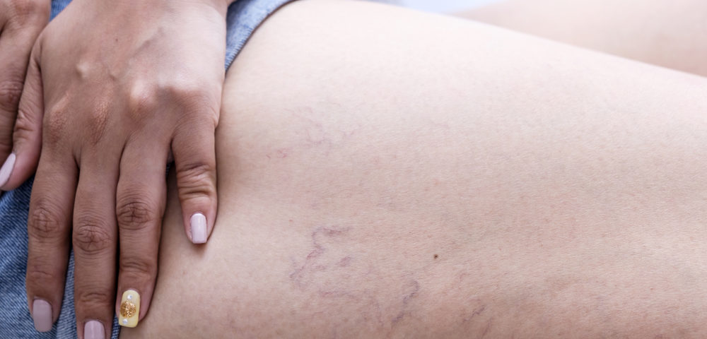 What Are Spider Veins?