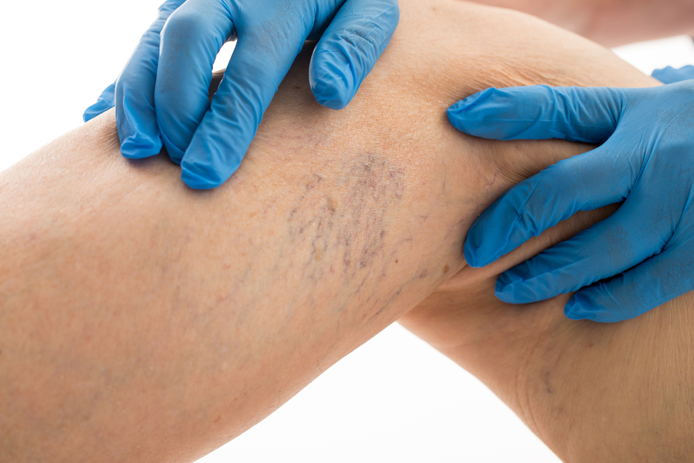 Chronic Venous Insufficiency Maryland