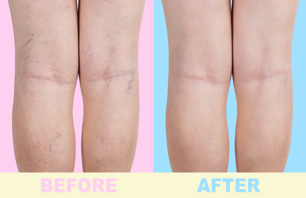 Varicose Veins Are a Woman's Issue and Other Myths - The Vein