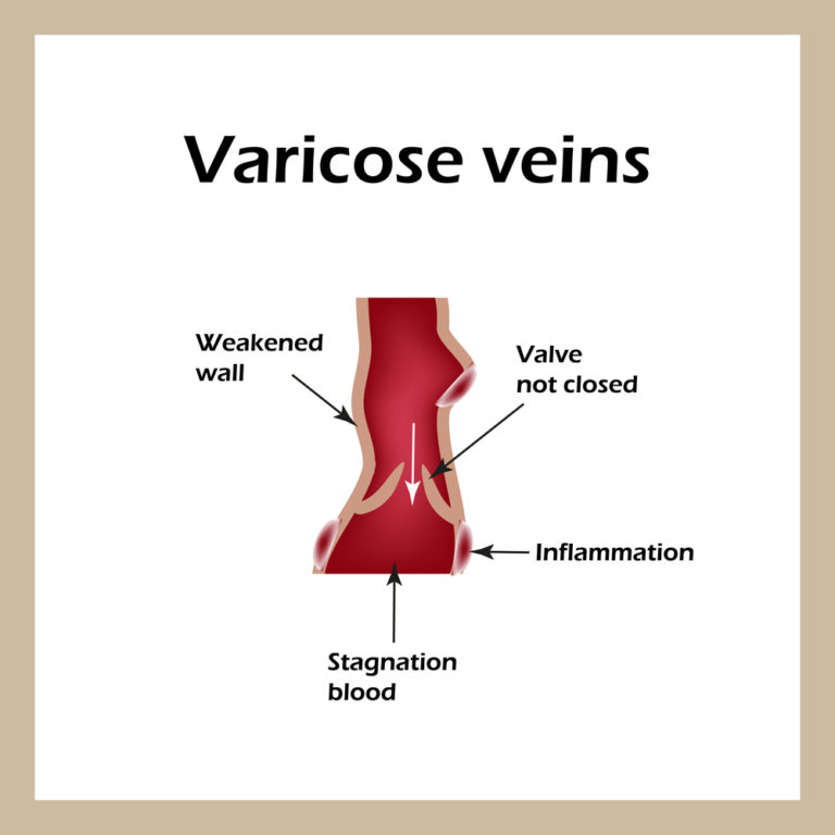 leg-pain-after-exercise-the-vein-center-of-maryland