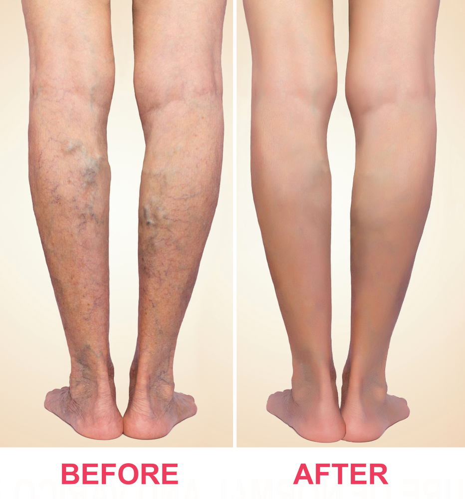 best compression stockings for varicose veins Archives - Delaware Vein  Center