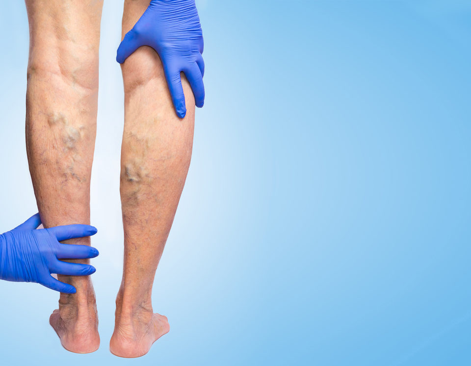Varicose Veins Frequently Asked Questions