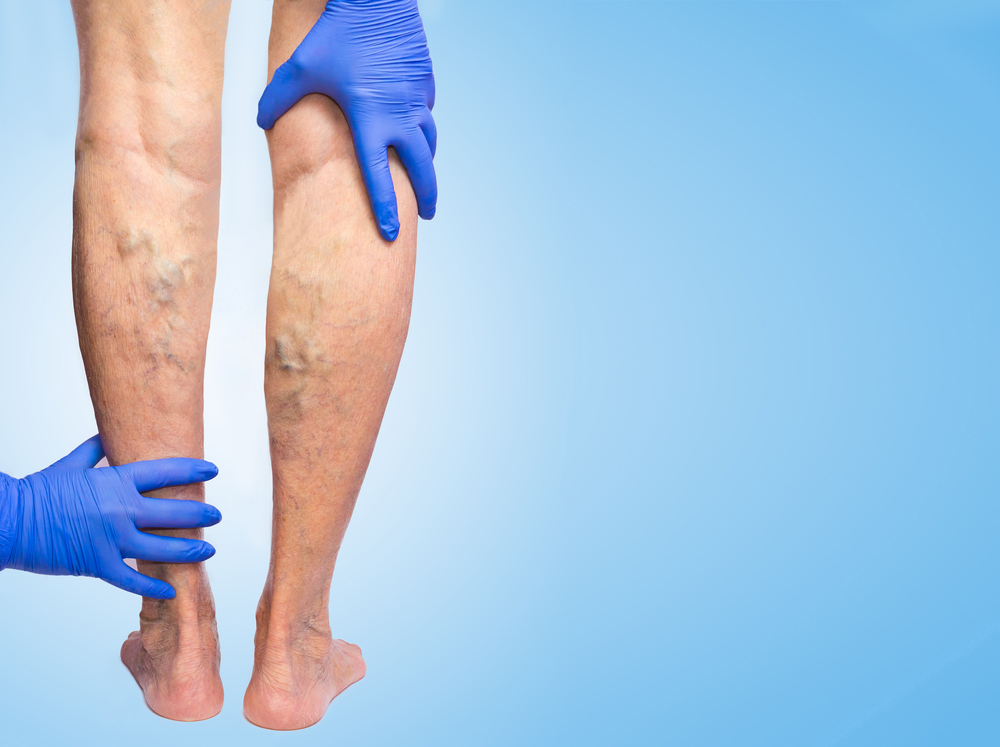 Varicose Veins Frequently Asked Questions