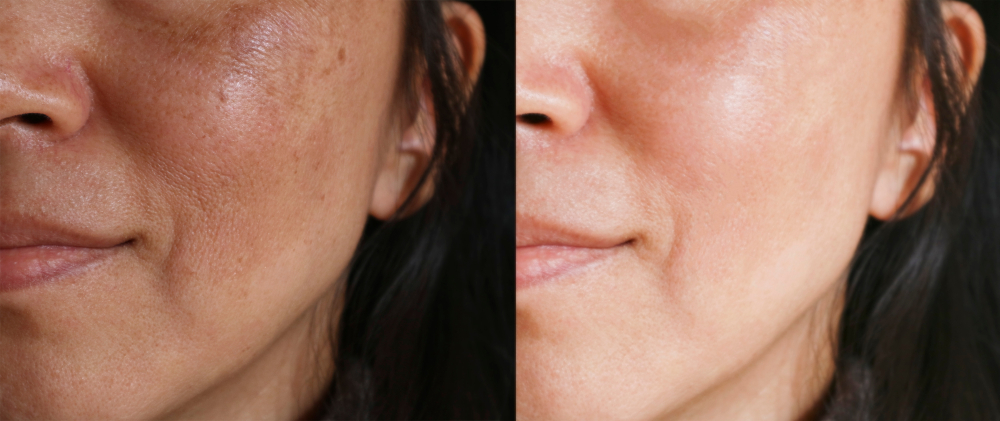 Ablative Laser Resurfacing Maryland