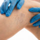 sclerotherapy procedure maryland