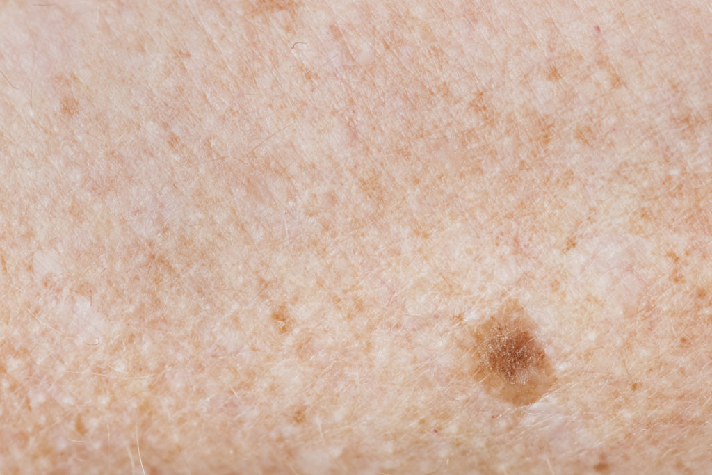 [コンプリート！] Melanoma Age Spots On Legs 346463 Can Age Spots Become