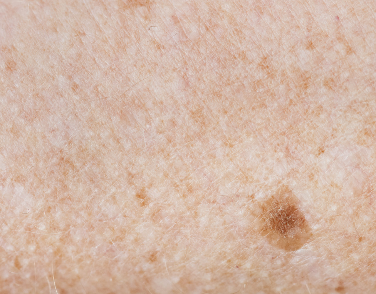 Liver Spots Vs Skin Cancer