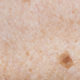 melanoma and age spots maryland
