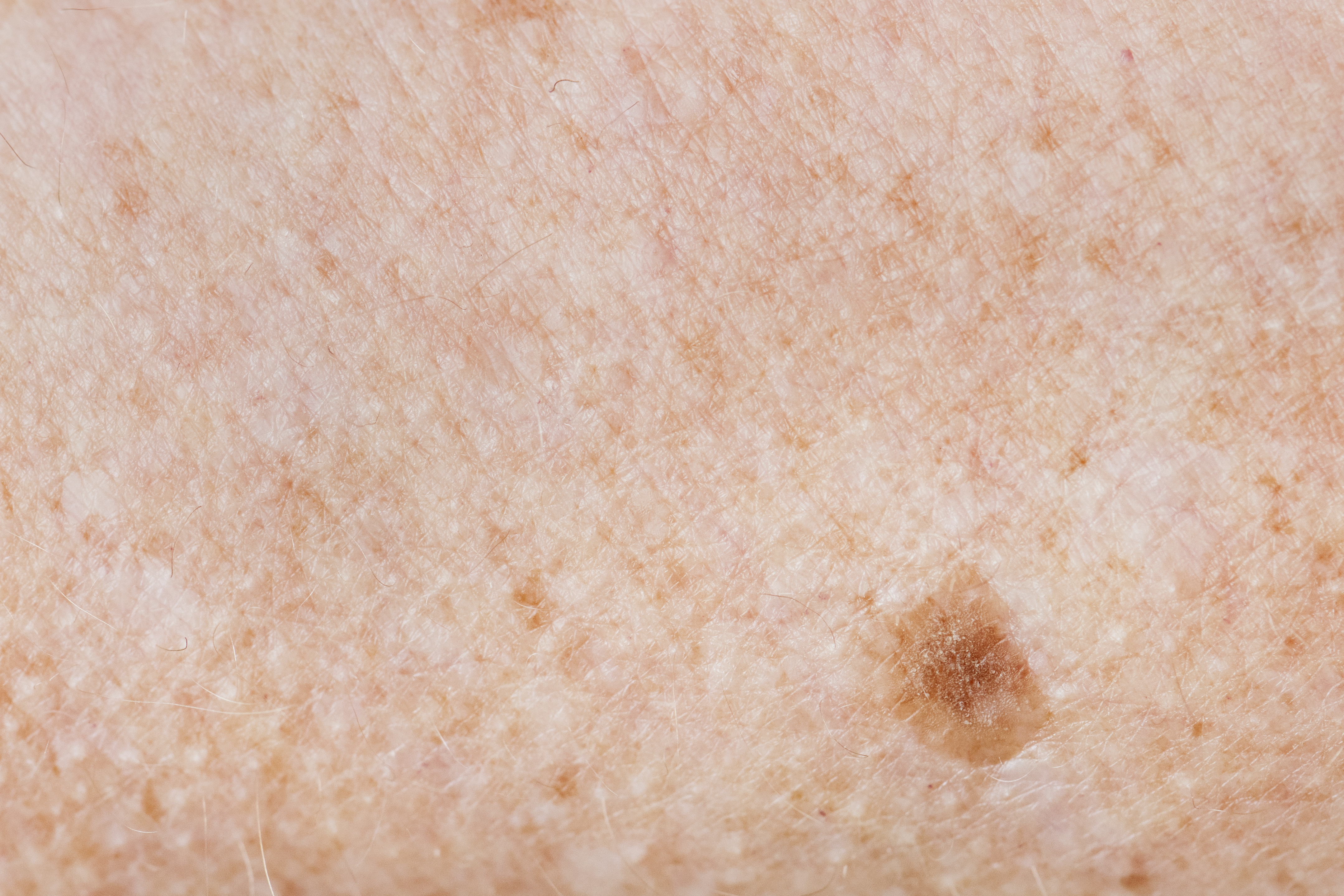 melanoma and age spots maryland