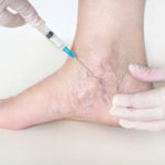 sclerotherapy columbia