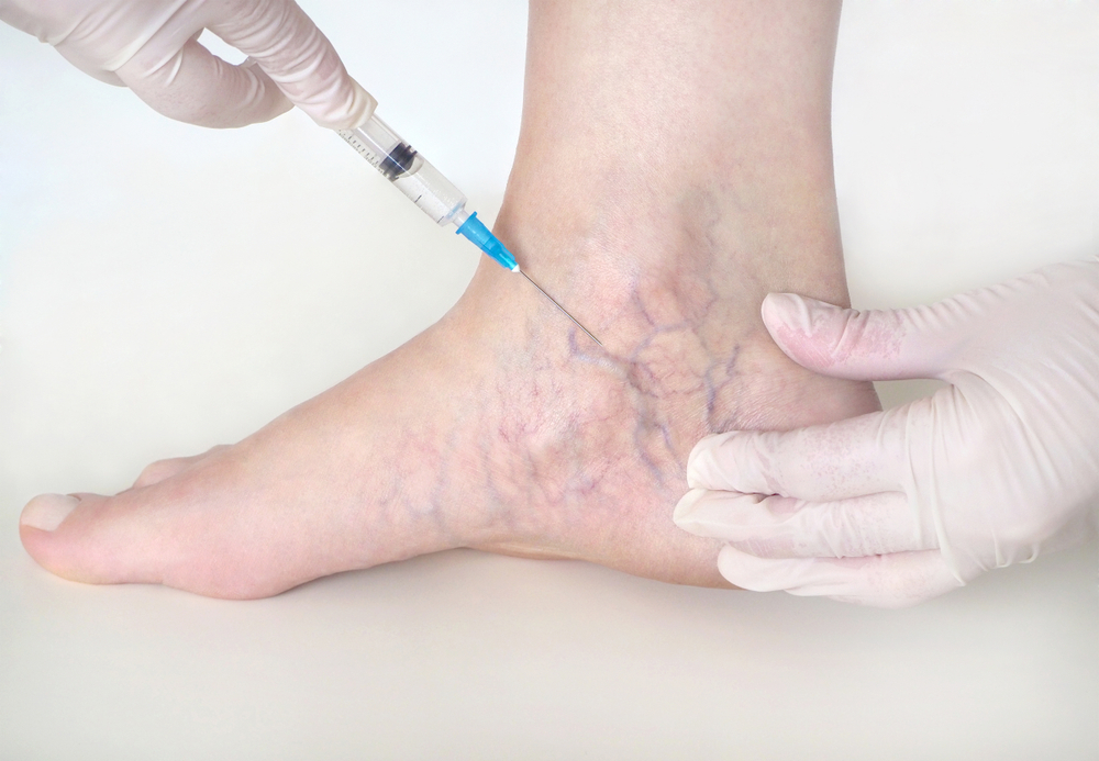 sclerotherapy columbia