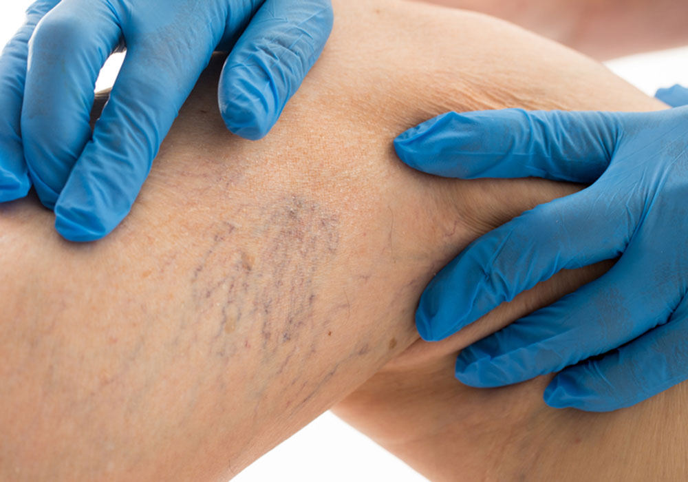 spider veins howard county