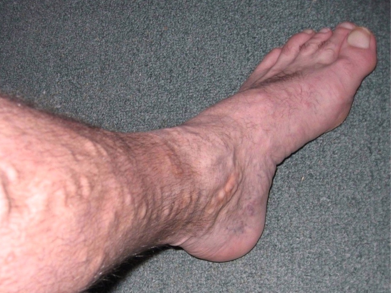 bulging varicose veins baltimore