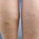 prepare for sclerotherapy maryland