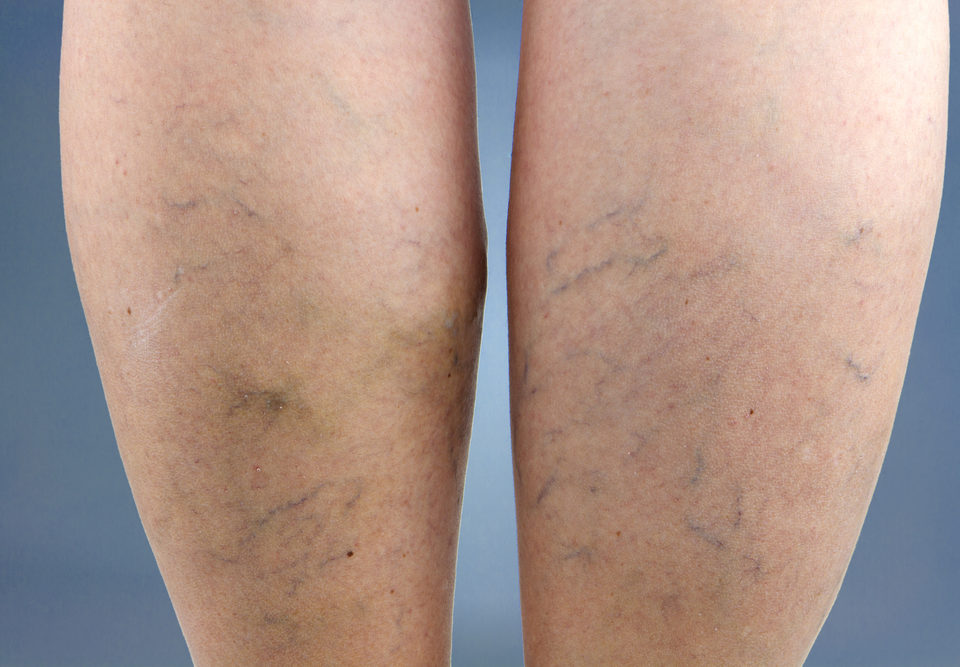 prepare for sclerotherapy maryland