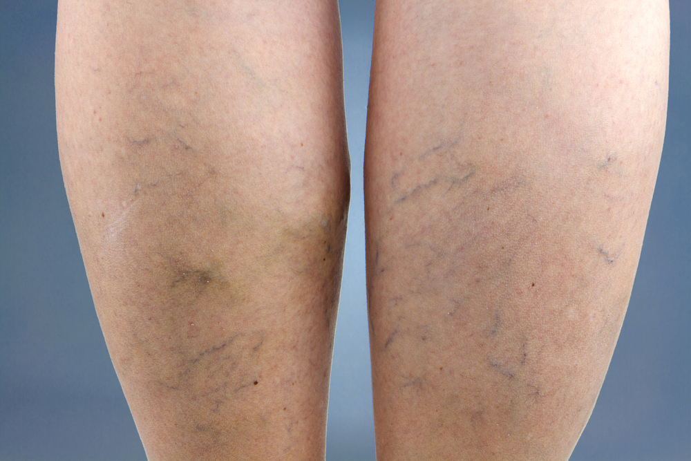 prepare for sclerotherapy maryland