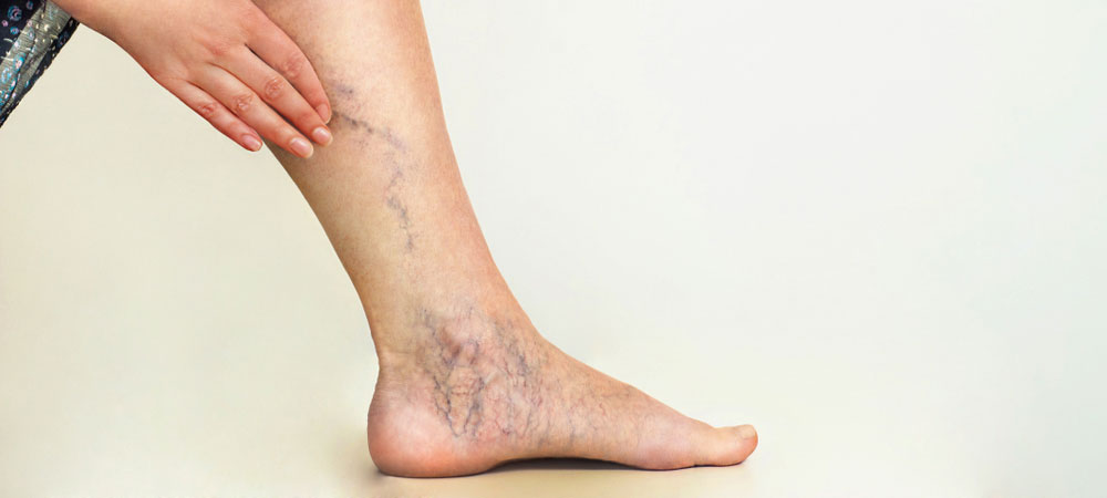 Spider Veins Maryland | Best Spider Vein Treatment | The Vein Center