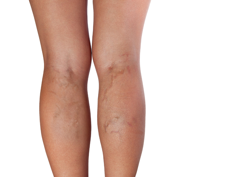 Varicele la picioare: ce sunt, de ce apar și cum le tratăm, Cum pot apărea venele varicoase