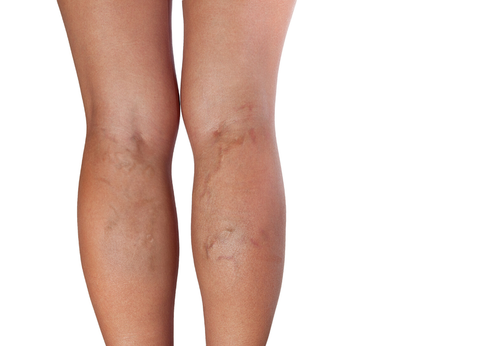 varicose vein or spider vein