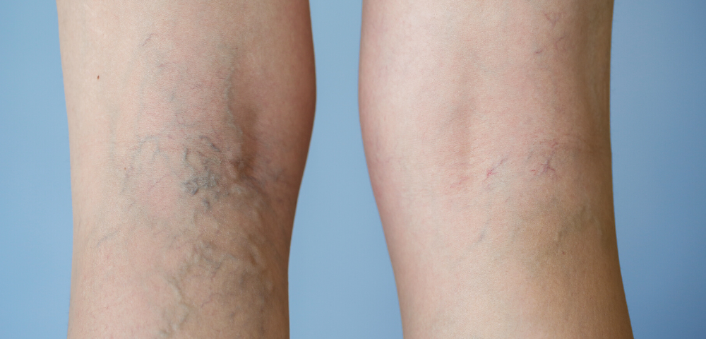 Can Varicose Veins Reoccur Varicose Veins Maryland The Vein Center