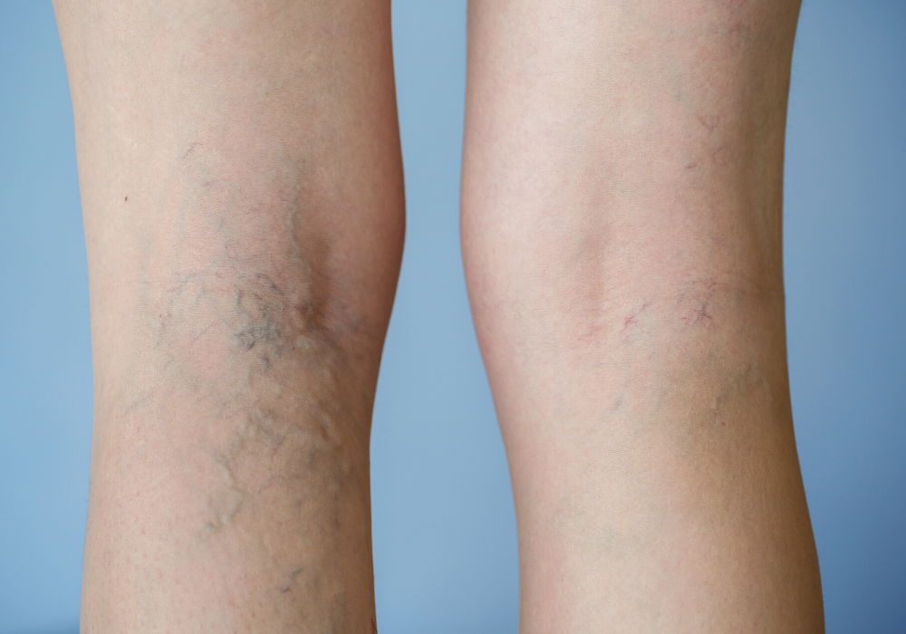 varicose veins reoccur