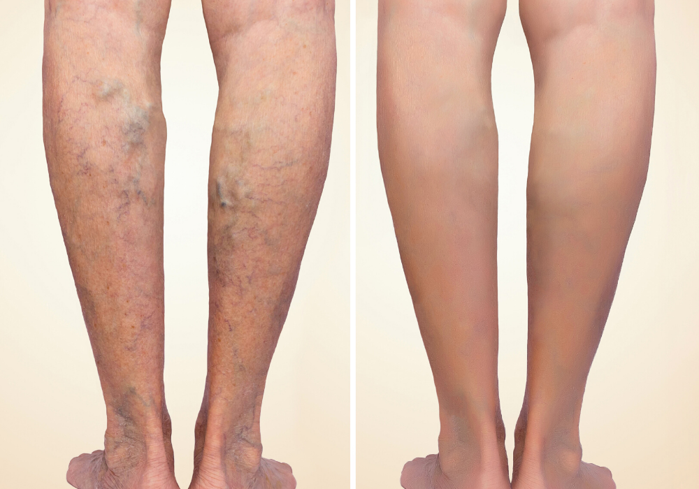 varicose veins columbia