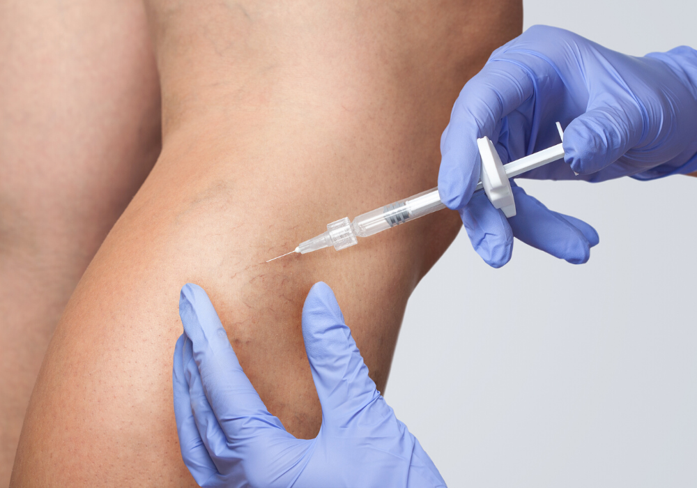 sclerotherapy laurel MD
