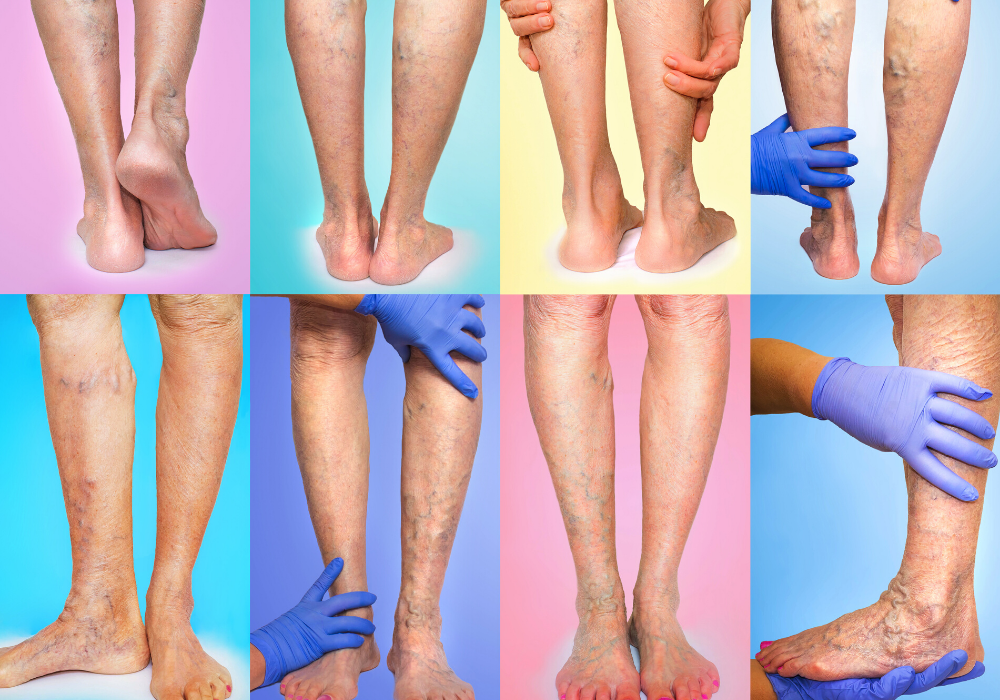 varicose veins maryland