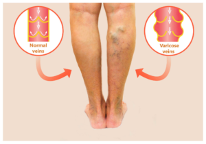 varicose veins maryland