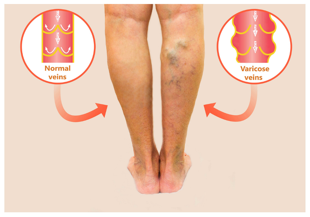 Sign of Worse Things to Come? Varicose Veins Vein Center of Maryland
