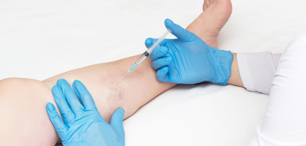 minimally invasive vein treatments in maryland