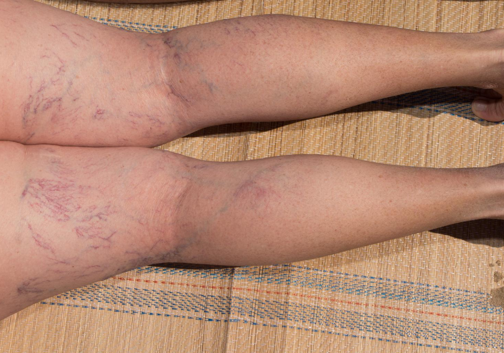 dangers of spider veins in columbia