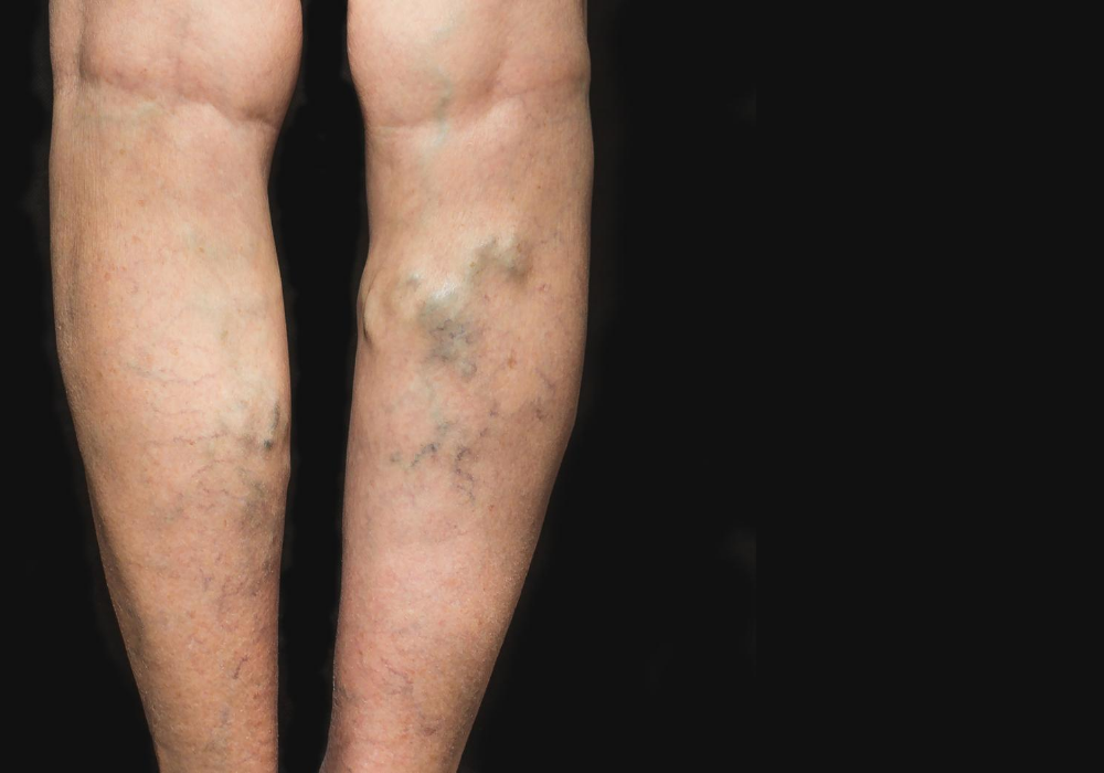 varicose veins in laurel maryland