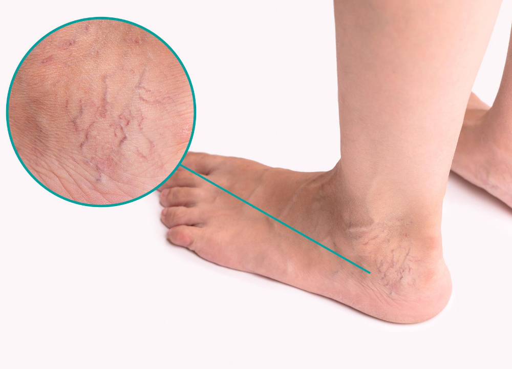 spider veins in columbia maryland