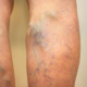 surgery or laser for varicose veins in columbia