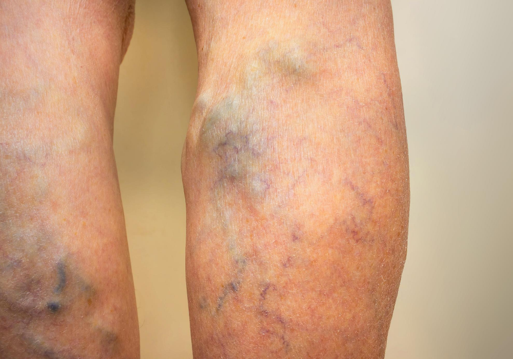 surgery or laser for varicose veins in columbia