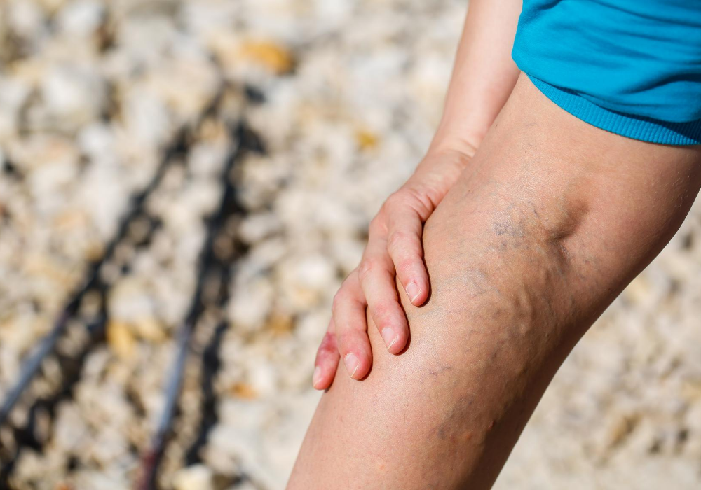 varicose veins columbia maryland