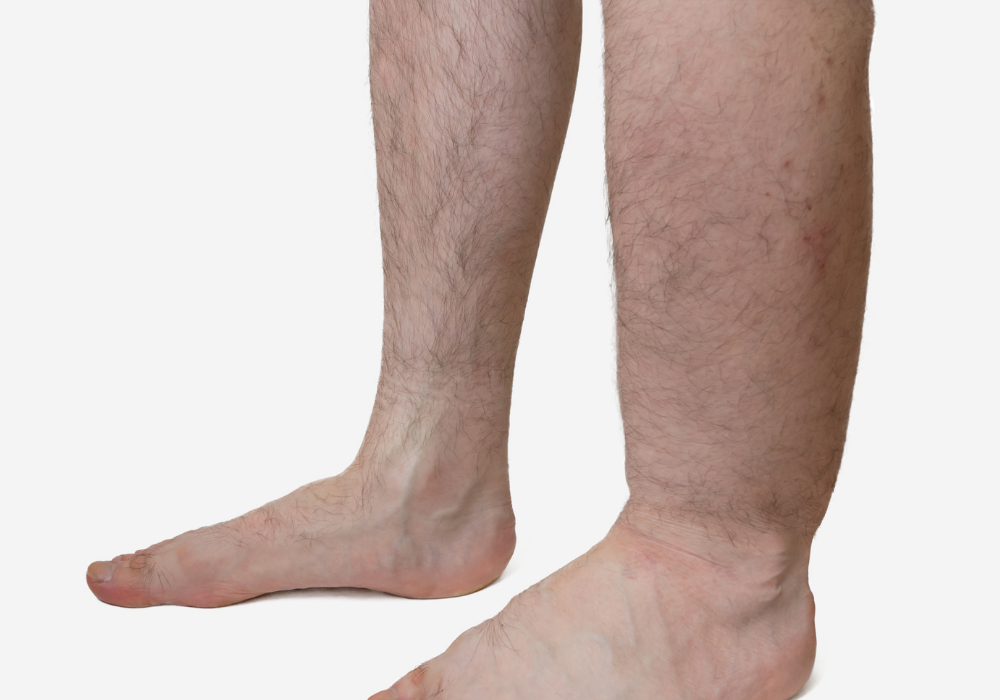 Edema | What is It + How Should It Be Treated? | The Vein Center