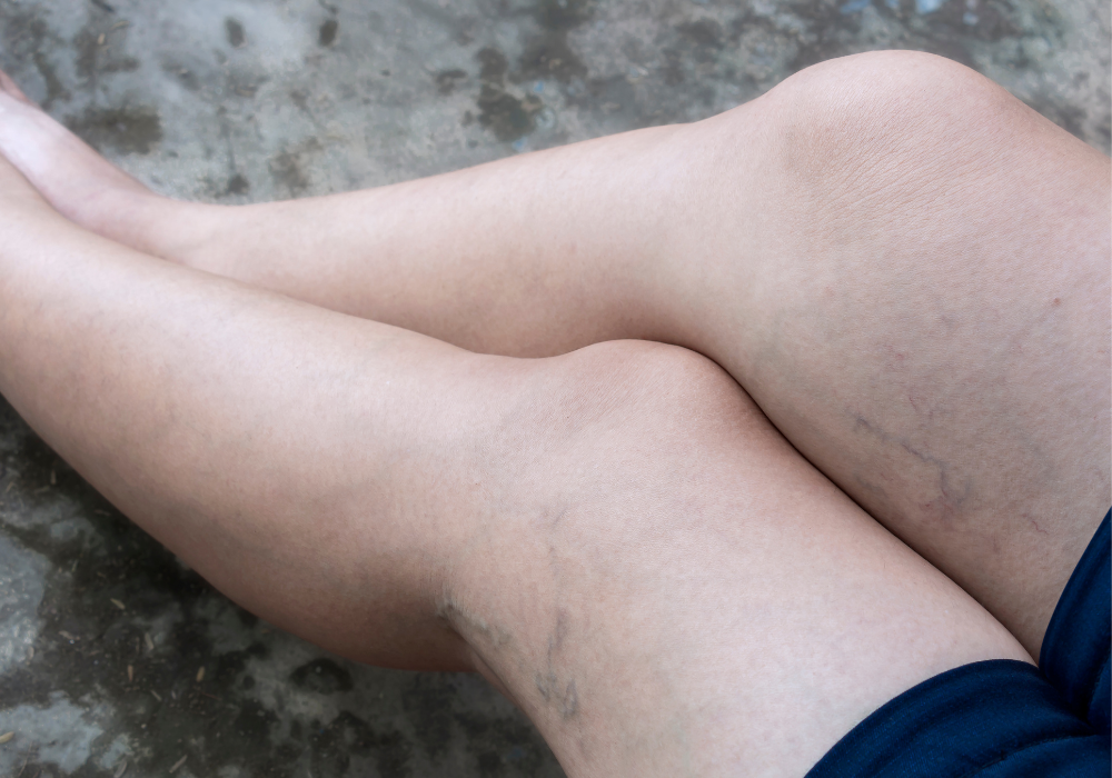 suffering from vein disease in maryland