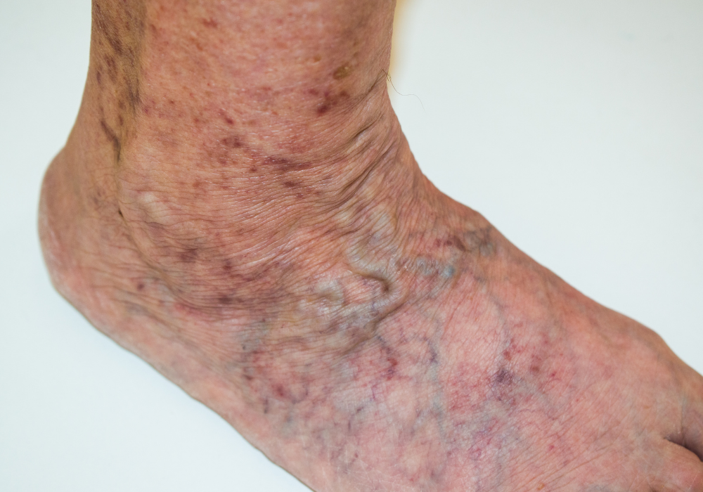 treat vein disease in maryland