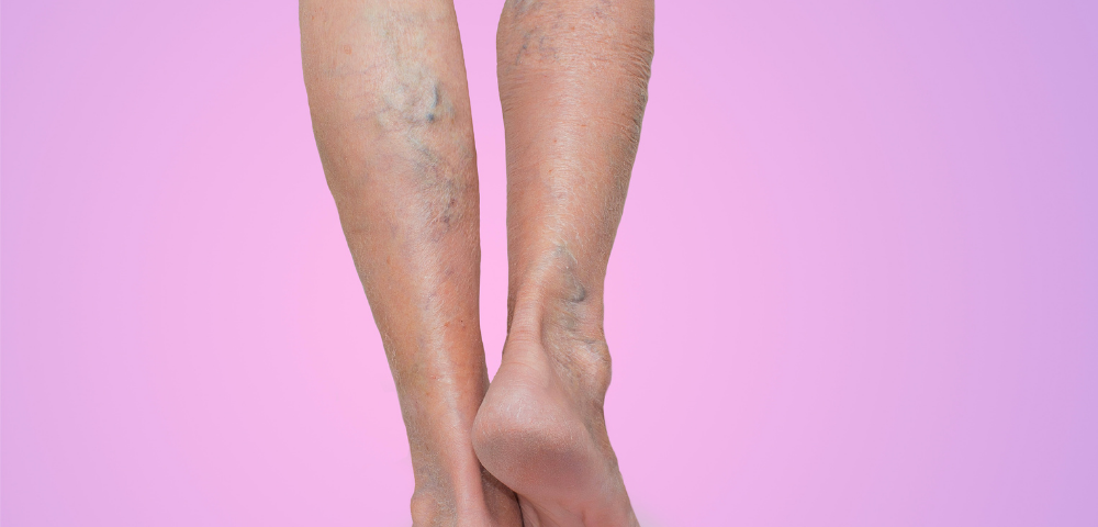 can varicose veins reappear