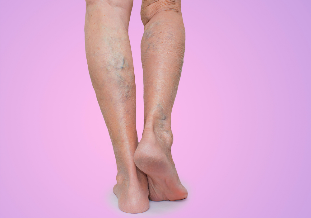 can varicose veins reappear