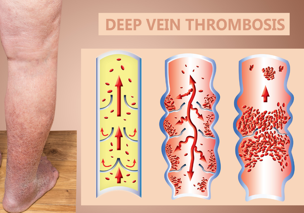 DVT, What is Deep Vein Thrombosis + Is It Dangerous?