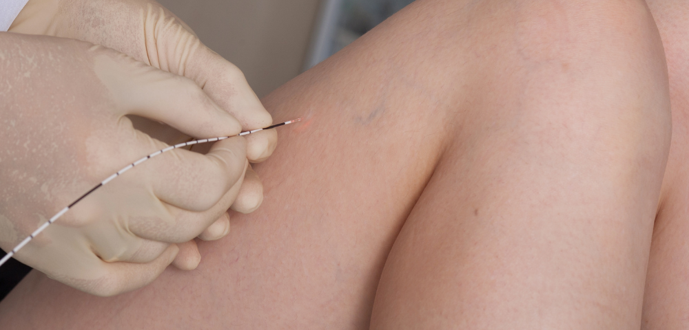 treatments for spider veins maryland