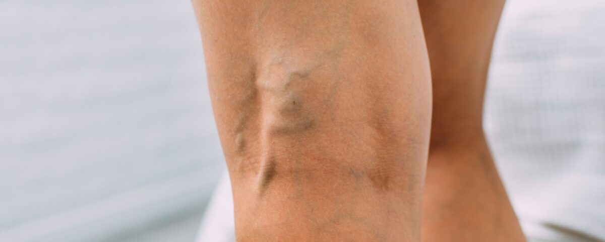 What Causes Veins to Show in Legs?
