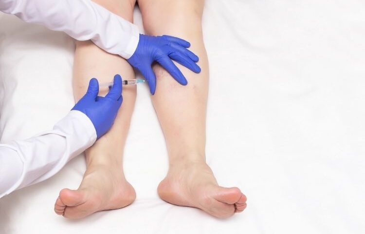 sclerotherapy specialist bel air md